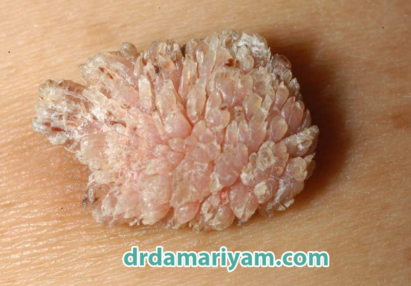 راه های انتقال زگیل تناسلی