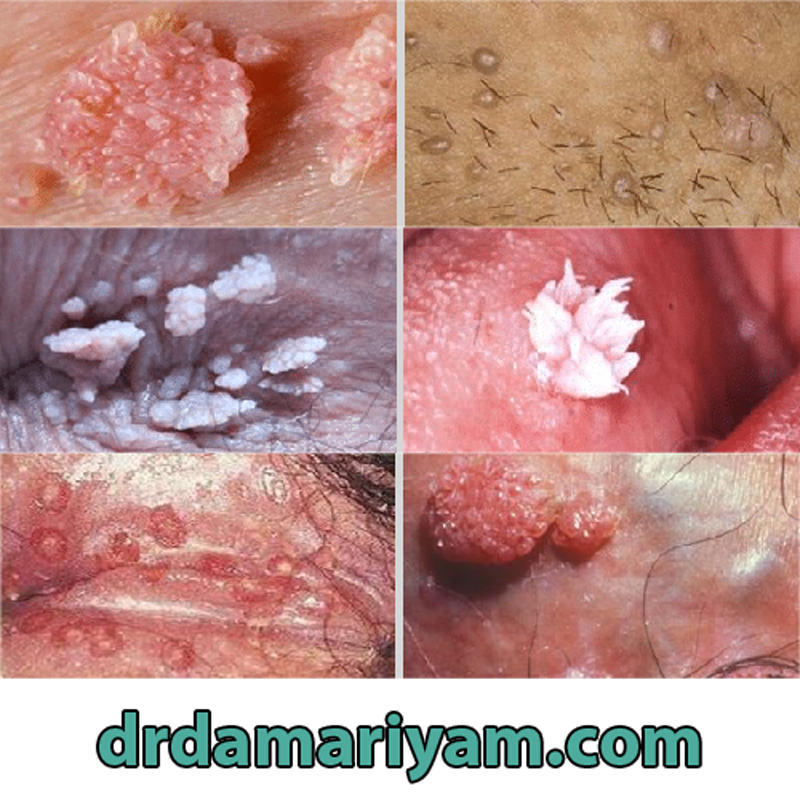 زگیل تناسلی در ناحیه مقعد زنان و مردان