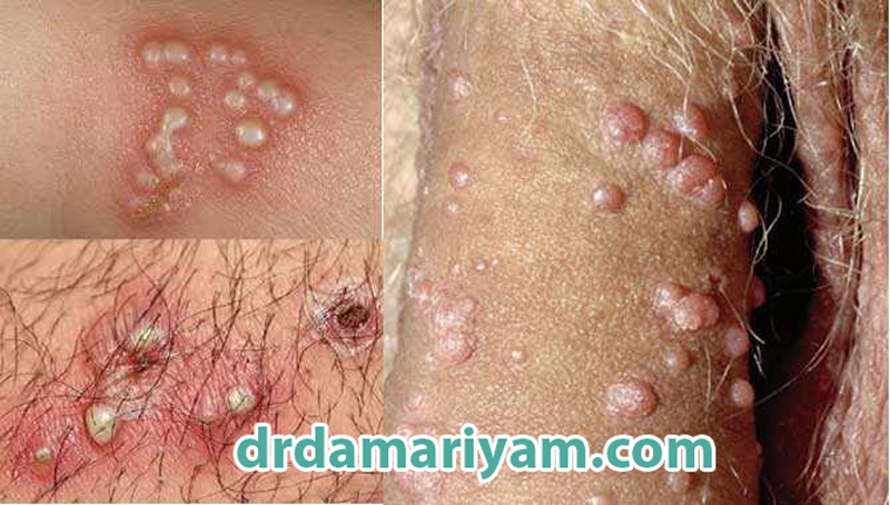 علائم زگیل تناسلی