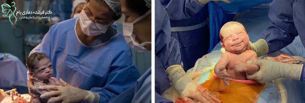 مراحل زایمان سزارین