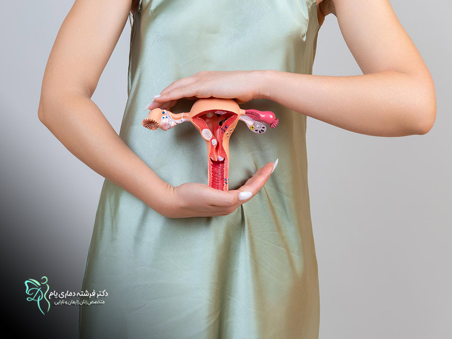 درمان کیست تخمدان