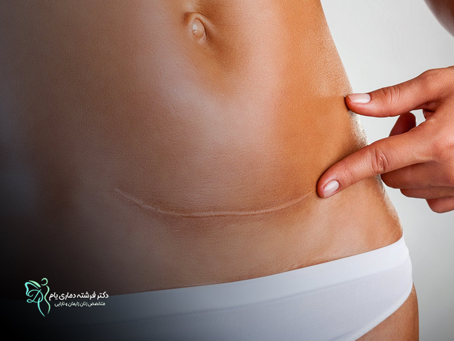 انواع بخیه‌های مورد استفاده در عمل سزارین