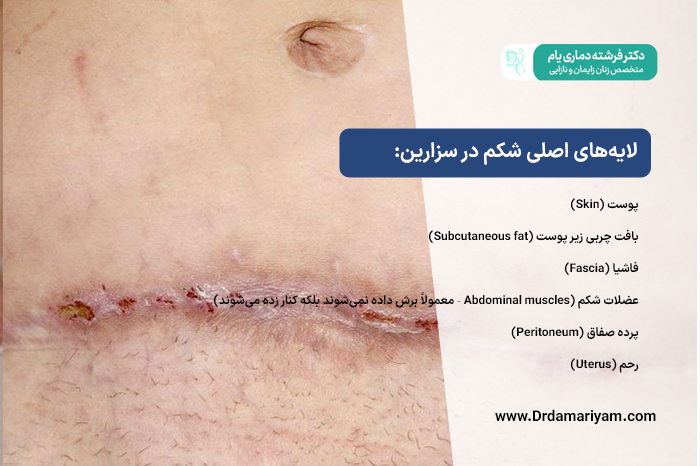 لایه‌های اصلی شکم در سزارین