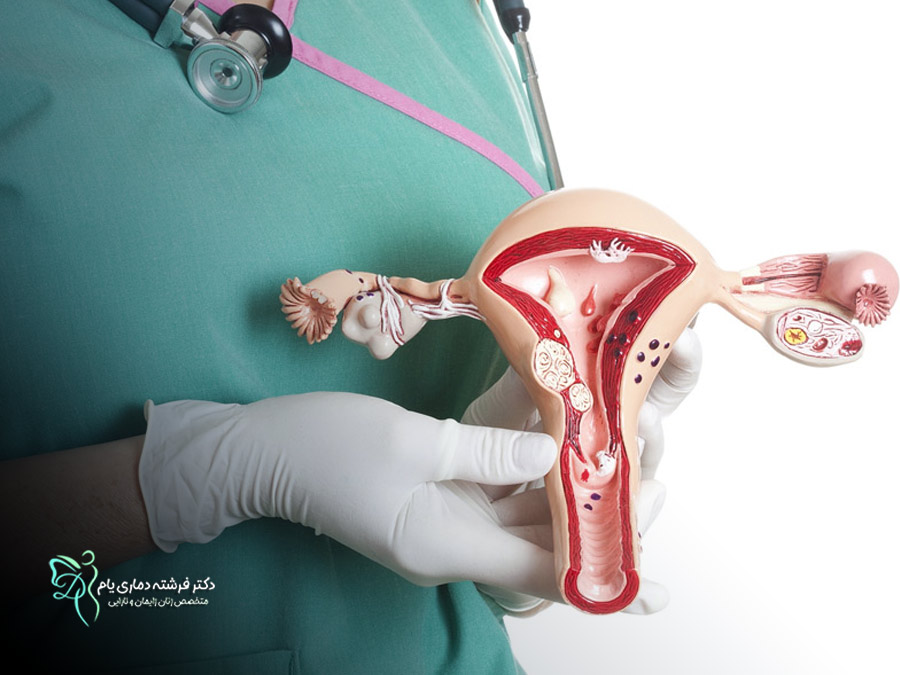 انواع بیوپسی دهانه رحم