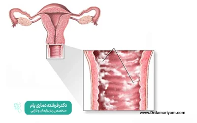 آیا ترشح پنیری خطرناک است؟راه درمان آن چیست؟